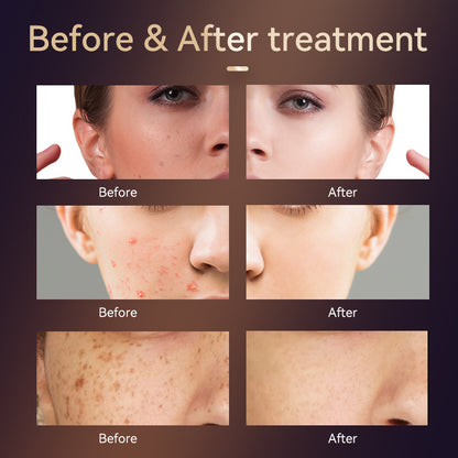 Home Four Band Photon Rejuvenation Device 10